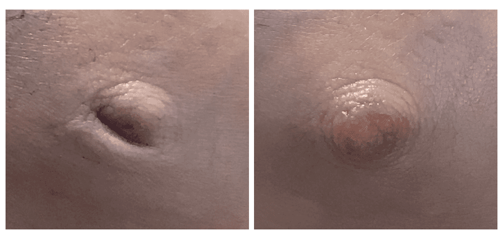 Nipple Correction Patient Photos in Pasadena, CA