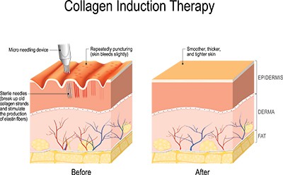 radiofrequency microneedling Pasadena