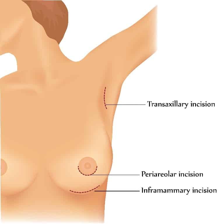 Breast Augmentation Pasadena CA Cosmetic Breast Implant Surgery