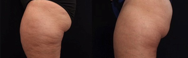 Cellulite Removal Patient Photos - Dr. Nima