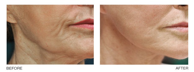 Wrinkle Treatment Options Pasadena CA Dr. Nima Plastic Surgery