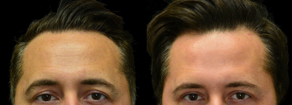 BOTOX Before and After Patient Photos