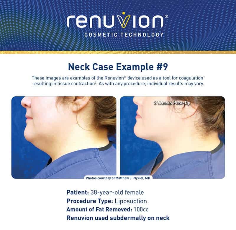 Skin Tightening Renuvion Patient Photos