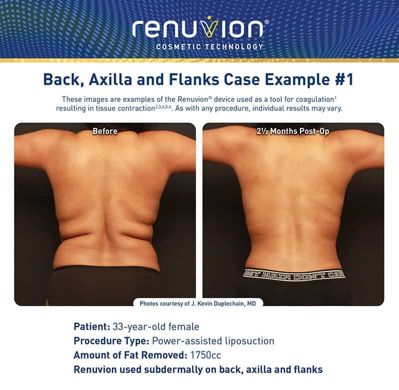 Bra Rolls Liposuction with VASER and Renuvion J-Plasma Skin Tightening