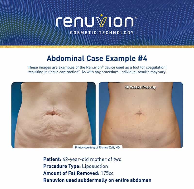 Patient Before and After Photos using Renuvion