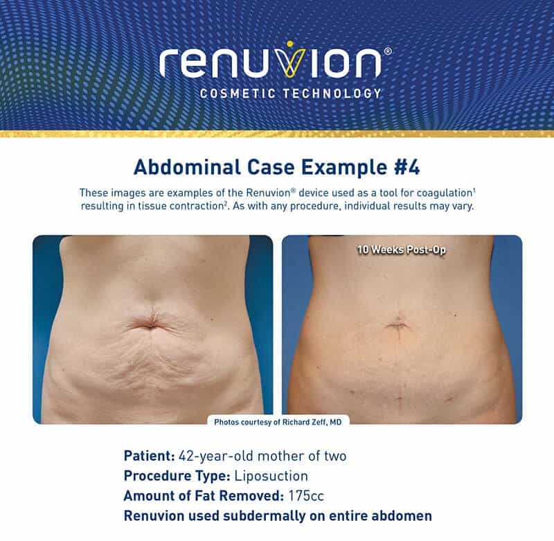 Before and After Photos of Tummy Tightening with Renuvion and