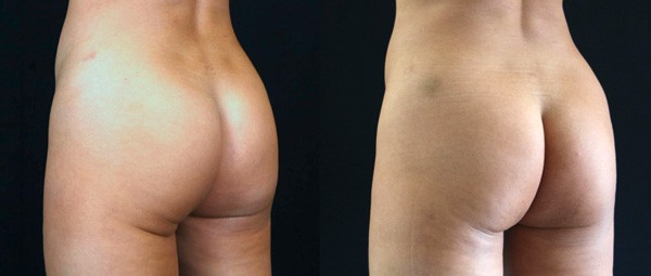 Renuva Buttock Patient Photos in Pasadena, CA