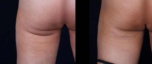 Butt Contouring with Profound RF Patient Photos
