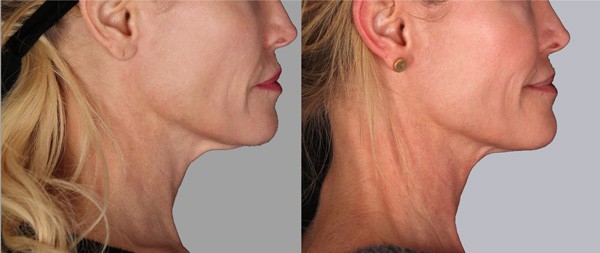 Profound RF for Skin Tightening