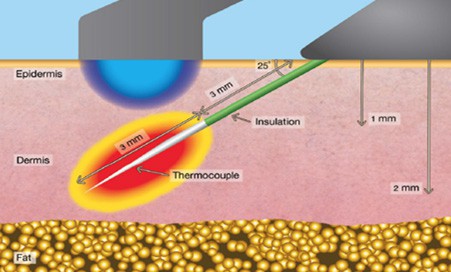 Profound RF Skin Tightening in Pasadena, CA