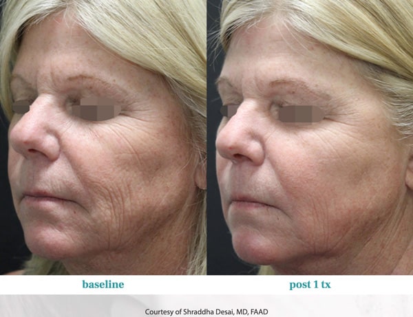 Opus Laser Before and After Patient Photos