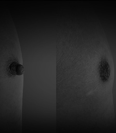 Male Nipple Correction in Pasadena, CA