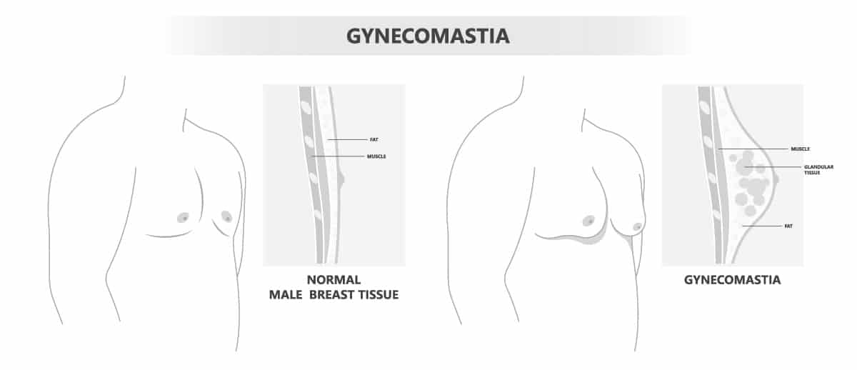 Gynecomastia Treatment in Pasadena, CA