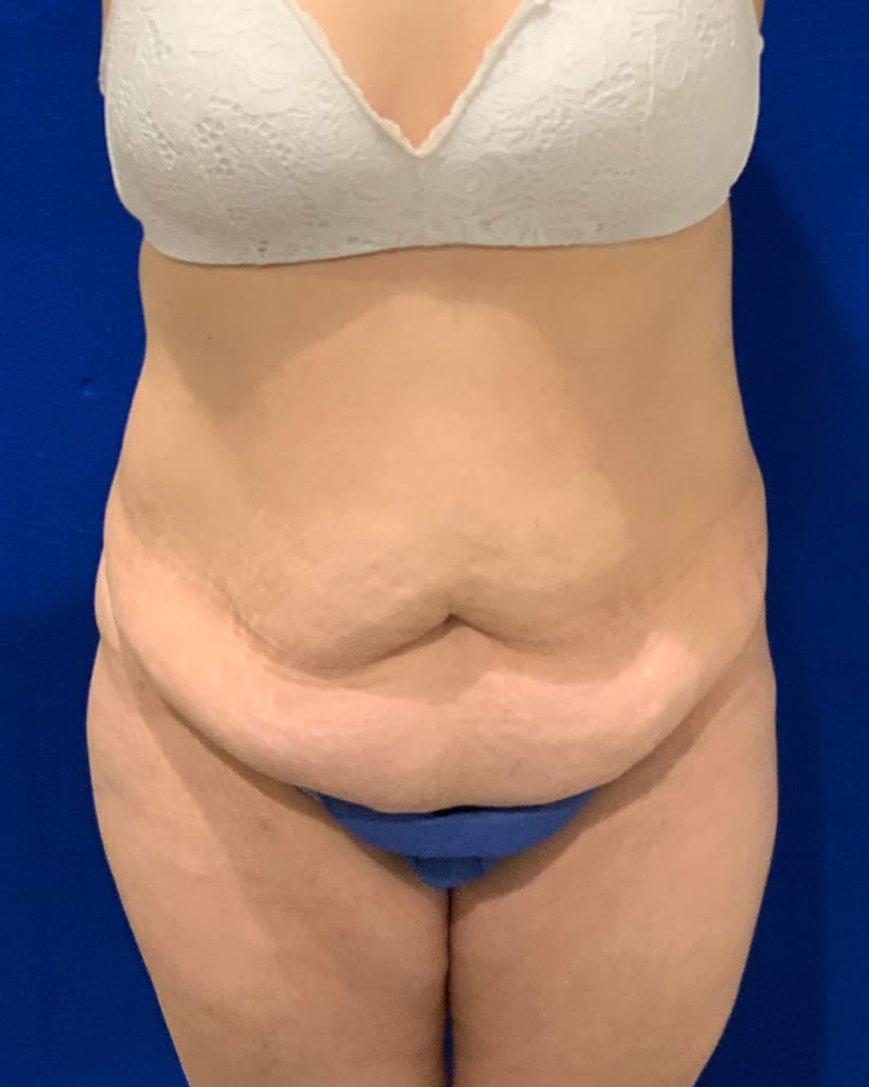 How Much Does a Tummy Tuck Cost? - Dr Rudy Coscia