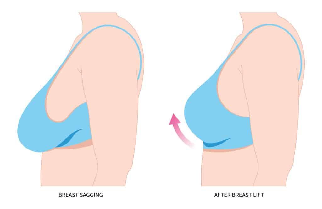 Breast lift surgeon Granite Bay