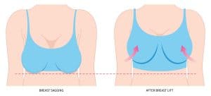 Correct Sagging, Droopy Breasts with Breast Lift Surgery - Folsom