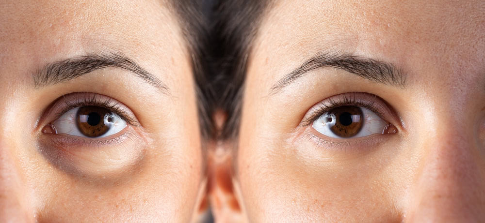 Droopy Eyes (Ptosis) Treatment in Sacramento