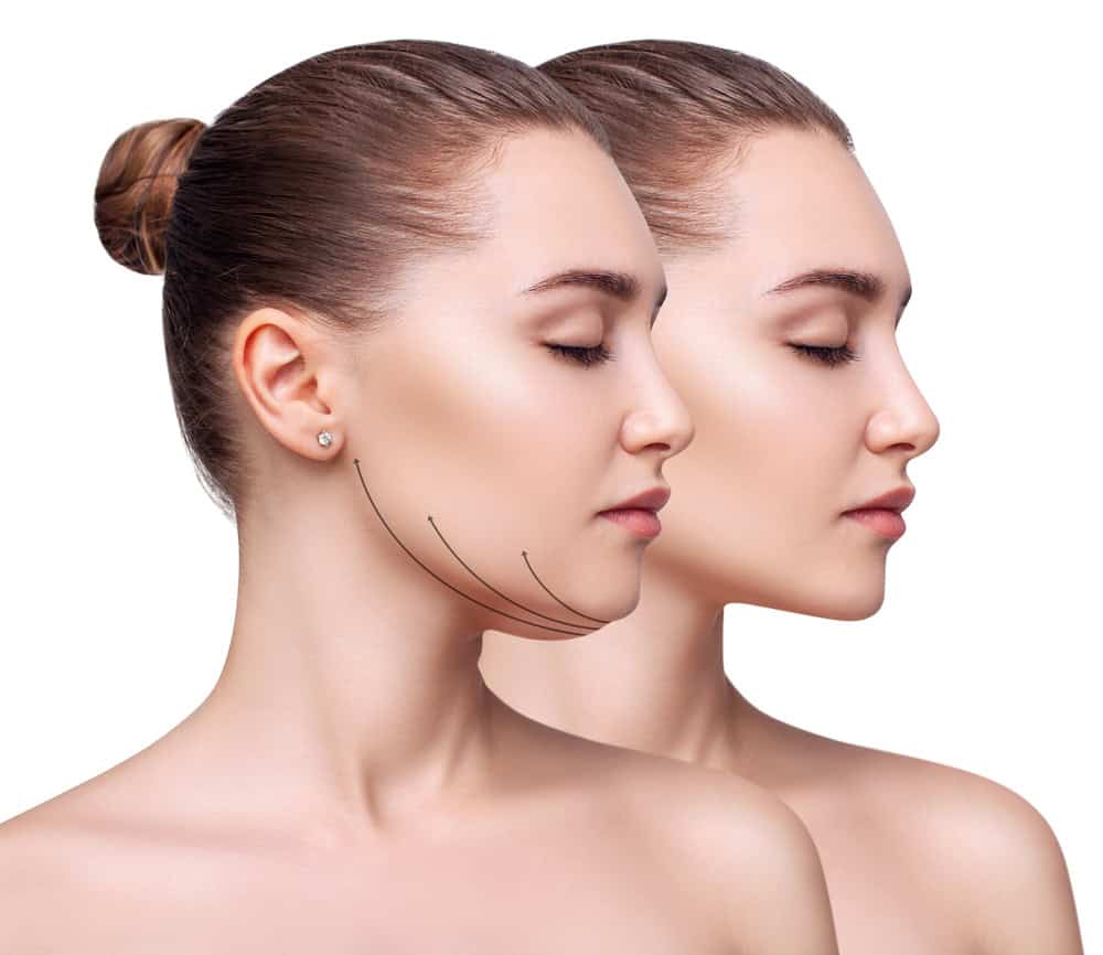 Before and after photos of woman who reduces her chin fat.