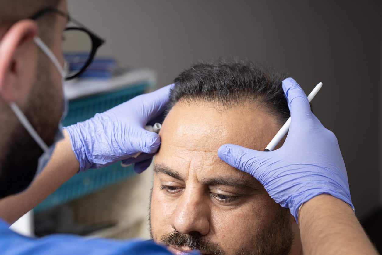 Clinician marks a man’s hairline in preparation for a NeoGraft hair transplant procedure.