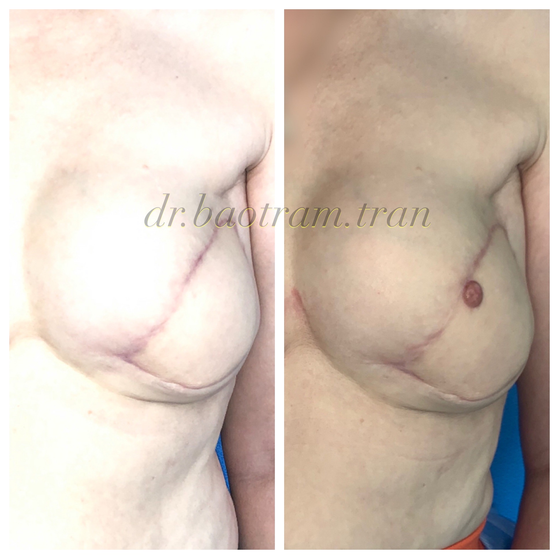 Nipple Reconstruction Before After Photos in Ft. Lauderdale