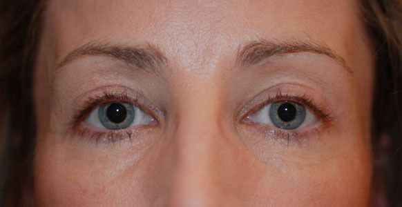 Blepharoplasty