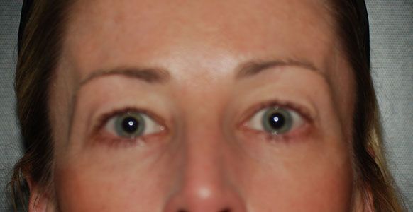 Blepharoplasty