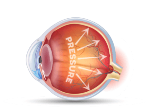 cross section graphic of eyeball showing pressure on the back of the eyeball