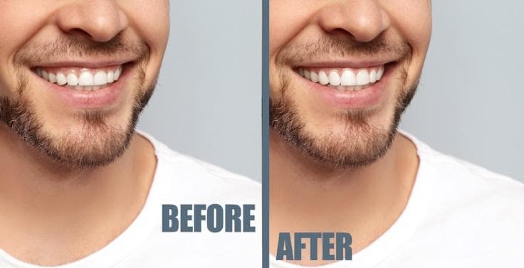 Laser Dentistry treatments Vancouver