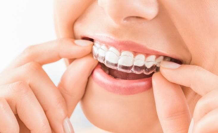 Invisalign in Vancouver 