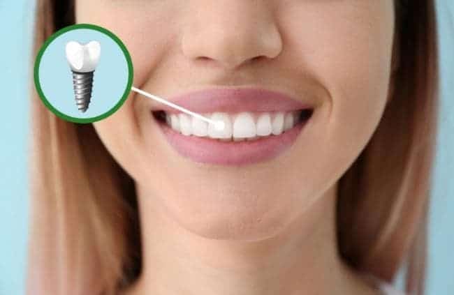 Dental Implants procedure Vancouver