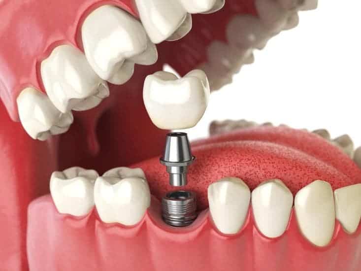 Dental Implants Vancouver 