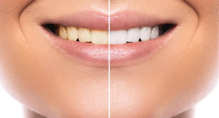 Teeth Whitening Vancouver