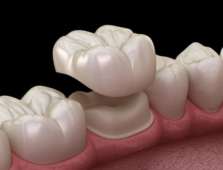 Dental Crowns Vancouver