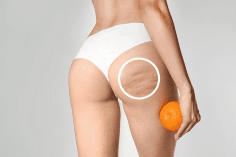 Cellulite Reduction Philadelphia