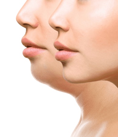 Non-surgical Neck Lift Philadelphia