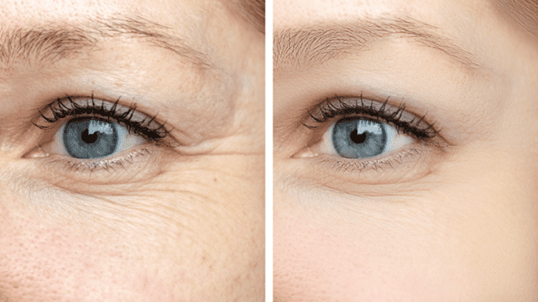 Non-Surgical Eyelid Rejuvenation in Philadelphia