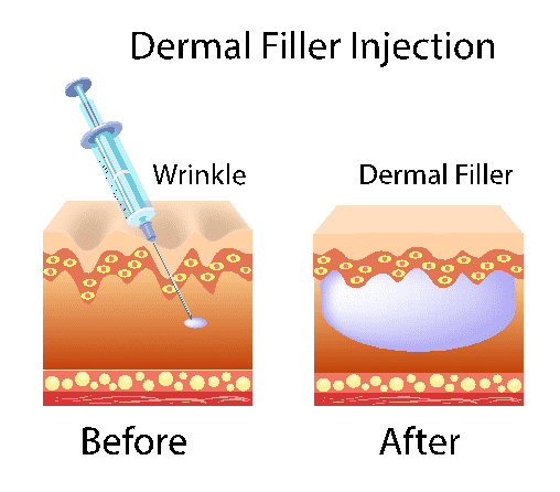 Dermal Fillers King of Prussia