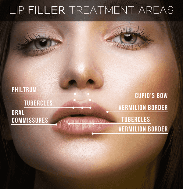 Our new lip filler: Restylane Kysse: Transformed Aesthetic and Wellness  Center: Laser & Medical Spa