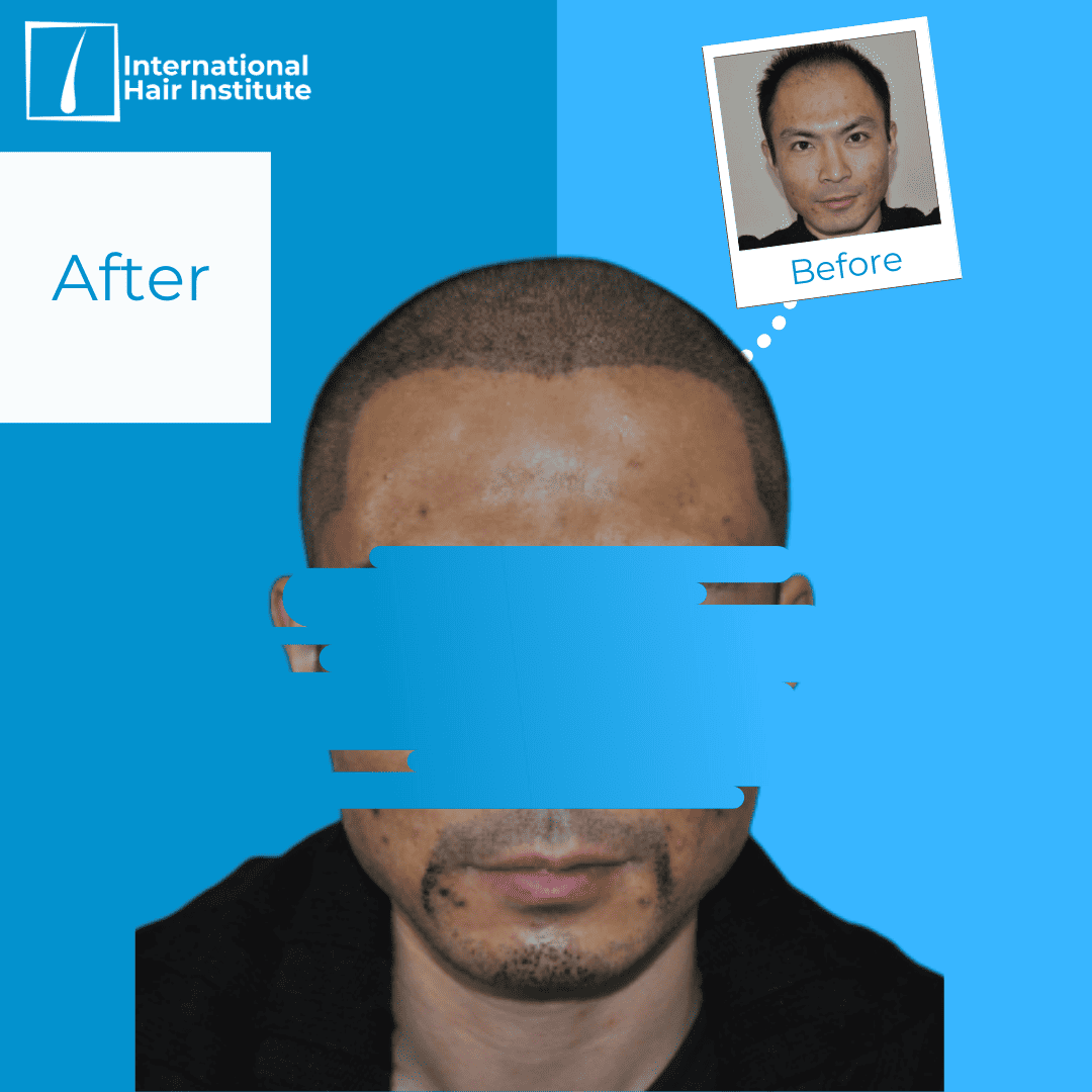 Skin  Surgery International  Asia Institute of Hair Transplant in Viman  Nagar Pune  Book Appointment View Contact Number Feedbacks Address   Dr Nitin Jain