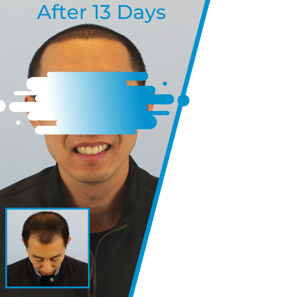 2600 Grafts Meng's Story Hair Transplant Chicago Ihiclinic