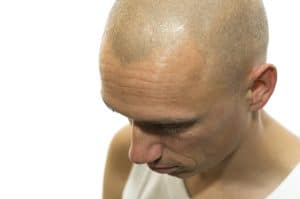 Why men hesitate to address hair loss