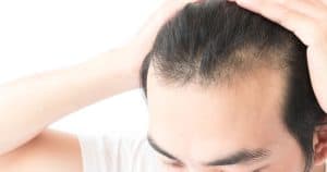 Hereditary-patterned baldness treatment in Chicago