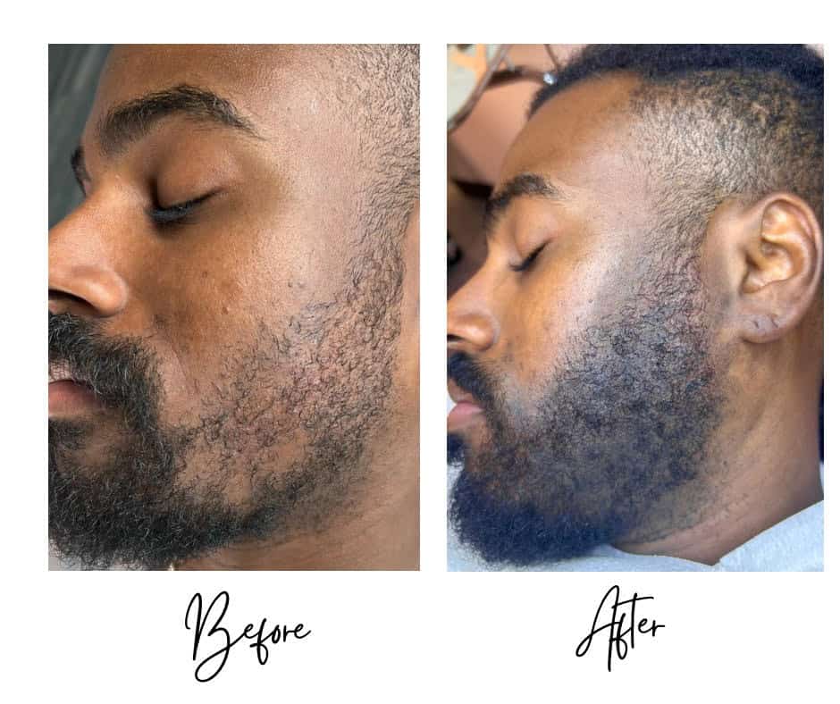 Micropigmentation Before & Afters
