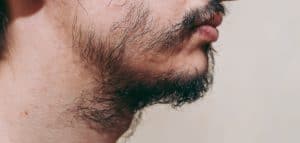 Beard transplant In Chicago, IL