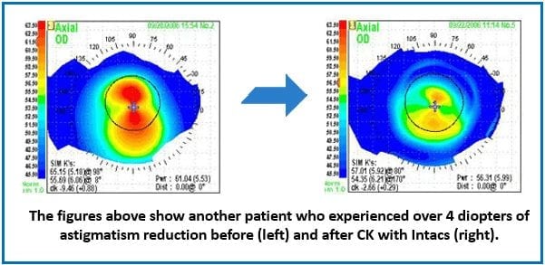 conductive keratoplasty combined with Intacs astigmatism