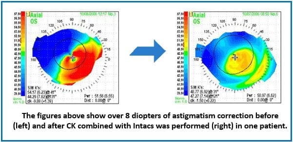 conductive keratoplasty combined with Intacs