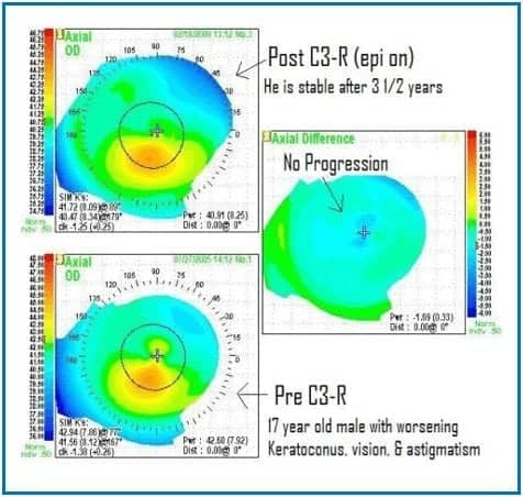 c3-r keratoconus corneal cross linking stability