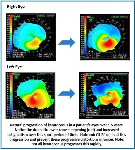 keratoconus progression