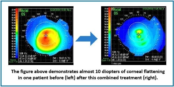 corneal flattening cross-linking intacs