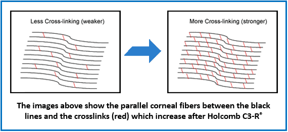 corneal crosslinking Holcomb C3-R keratoconus